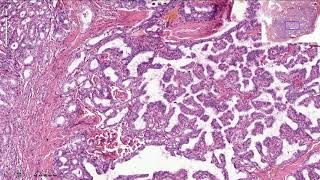 Papillary Thyroid Carcinoma  Histopathology [upl. by Pavel]