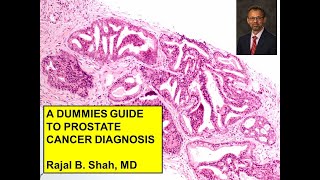 A Dummies Guide to Prostate Cancer Diagnosis [upl. by Bassett895]