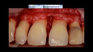 Periodontal Surgery Upper Front Teeth [upl. by Anirdua893]