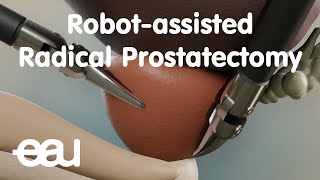 Robotassisted Radical Prostatectomy RARP [upl. by Torre]