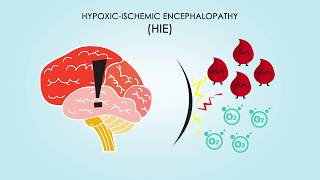 Hepatic Encephalopathy  causes symptoms treatment [upl. by Enomis524]