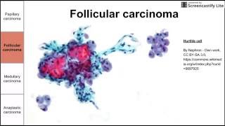 Thyroid Cancers [upl. by Orutra]