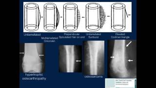 Bone Lesions Radiographic Assessment Part 1 by Geoffrey Riley MD [upl. by Ehttam]