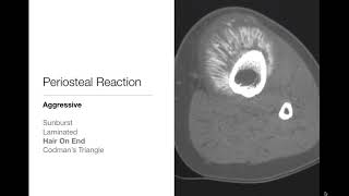 Bone Tumors  Periosteal Reaction  Radiology Basics [upl. by Johannessen369]