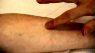 How to take a TB Skin Test [upl. by Arbmat]