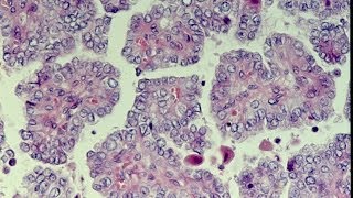 High grade papillary urothelial carcinoma Grade 3 TCC [upl. by Krisha983]