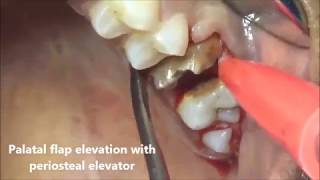 Root stump of molar extraction using periosteal elevator [upl. by Byler]